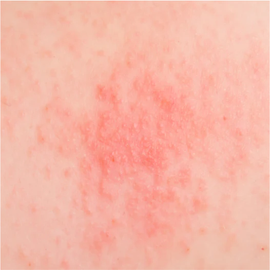 Eczema-prone Skin Care